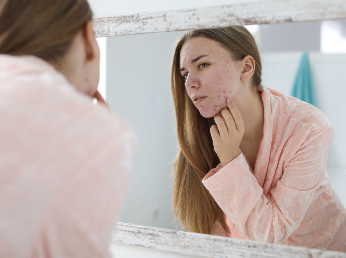 női - aknéra hajlamos bőr 