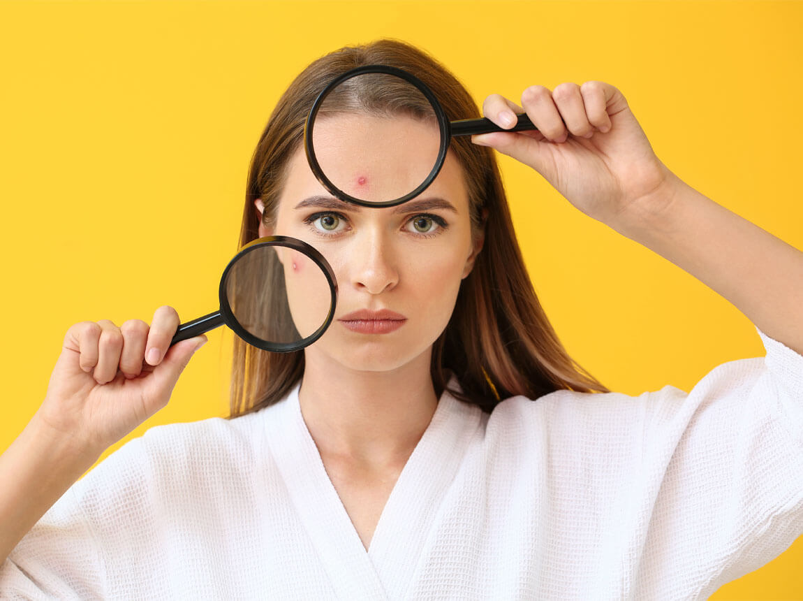 női - aknéra hajlamos bőr 