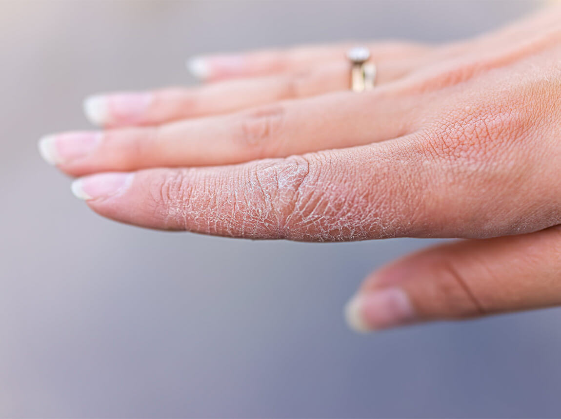 repedezett bőr a kezeken 