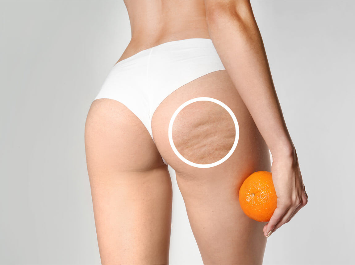 nő - cellulitisz a lábakon 