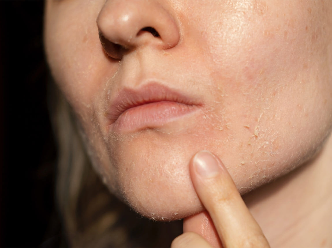 nő - sz&aacute;raz bőr 