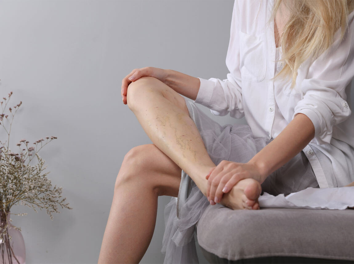 nő - visszér a lábakon 