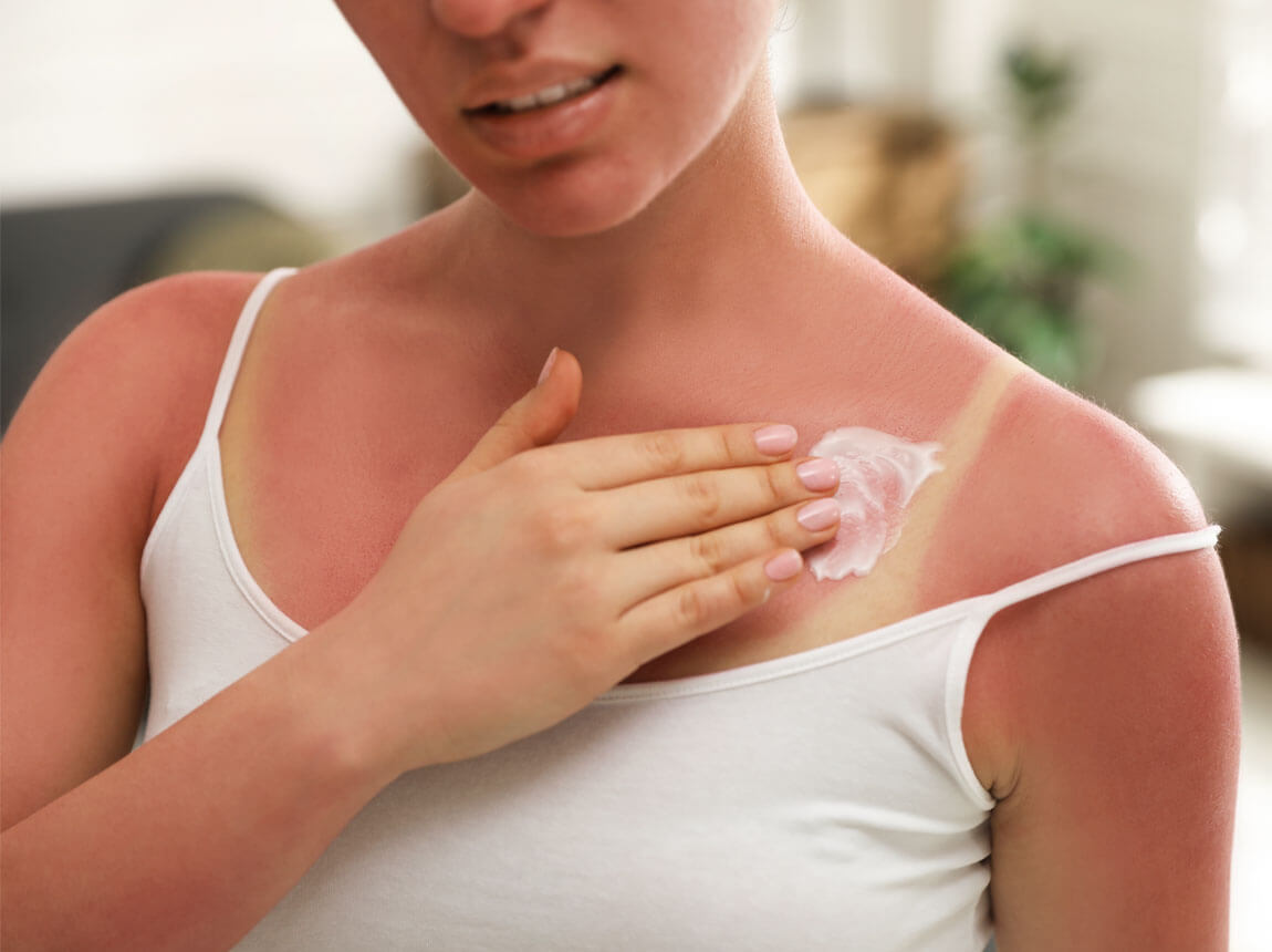 napfény Elleni védelem