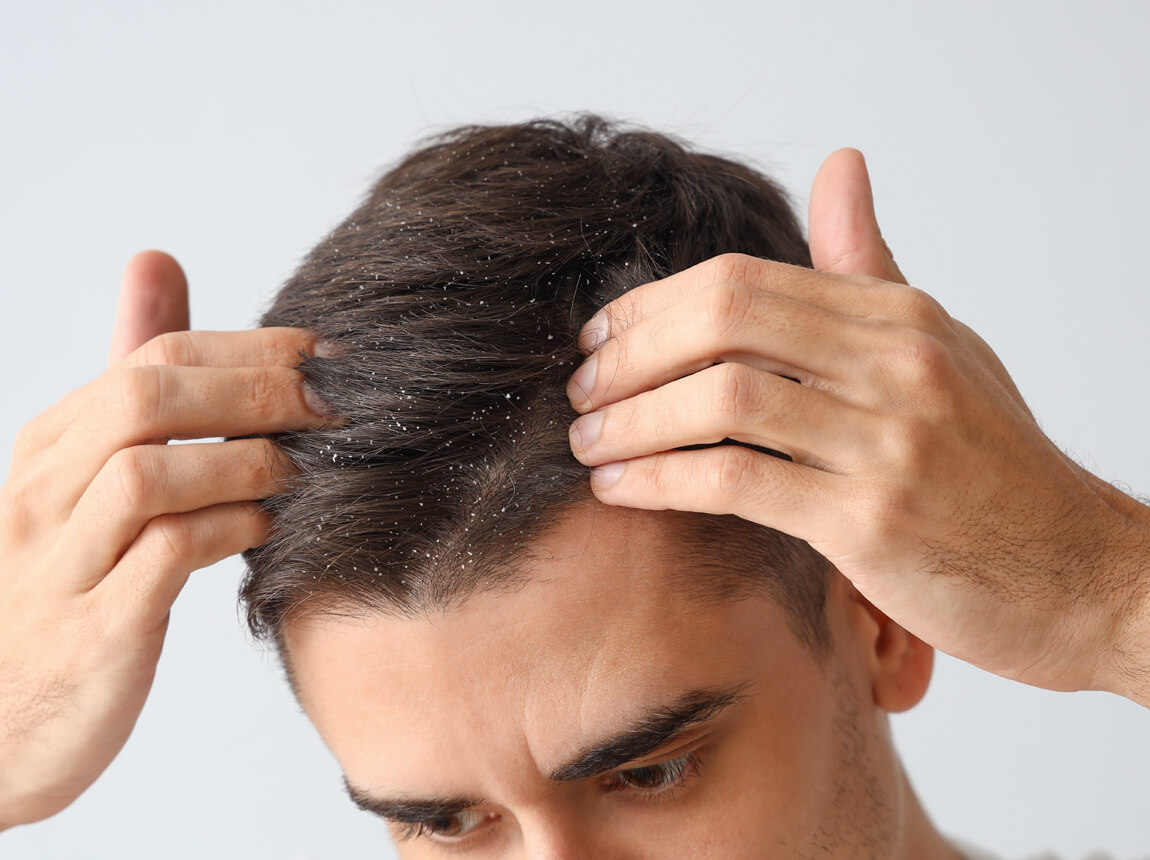 férfi korpa a fejen 