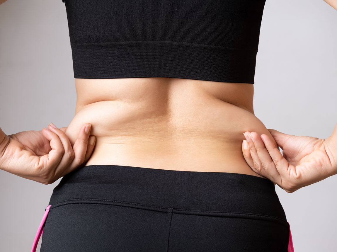 probléma a fogyással - hájcsomók