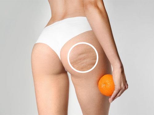 Cellulitisz a combokon és a fenéken – hogyan lehet megszabadulni tőle?