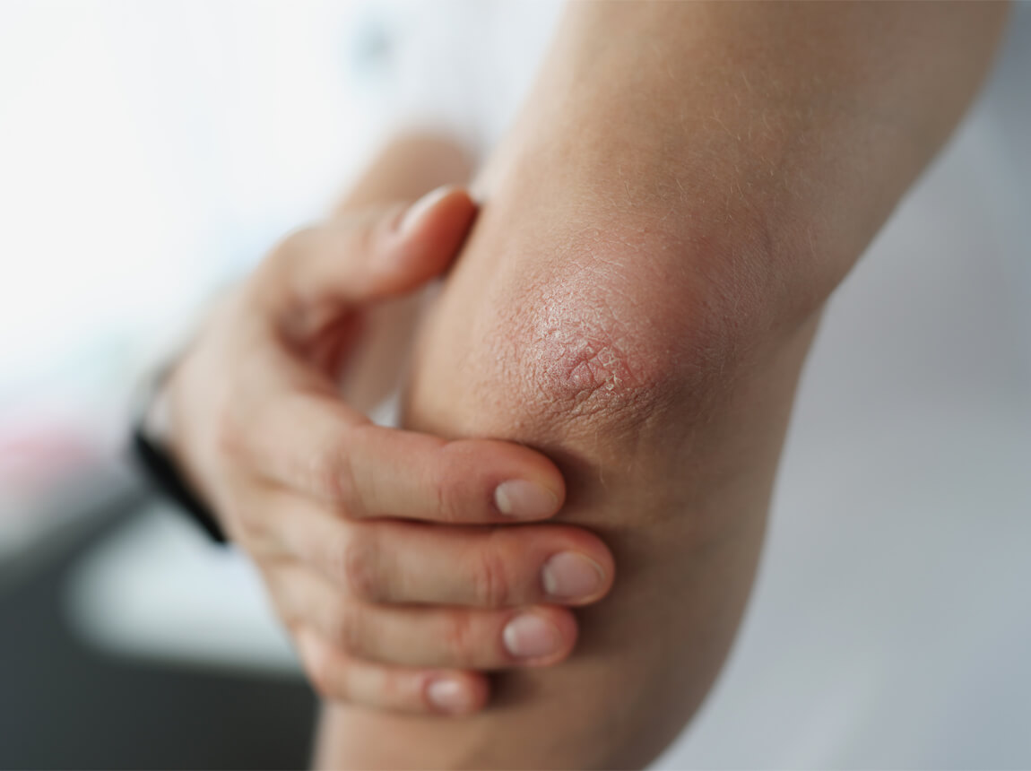 száraz bőr a könyökön 